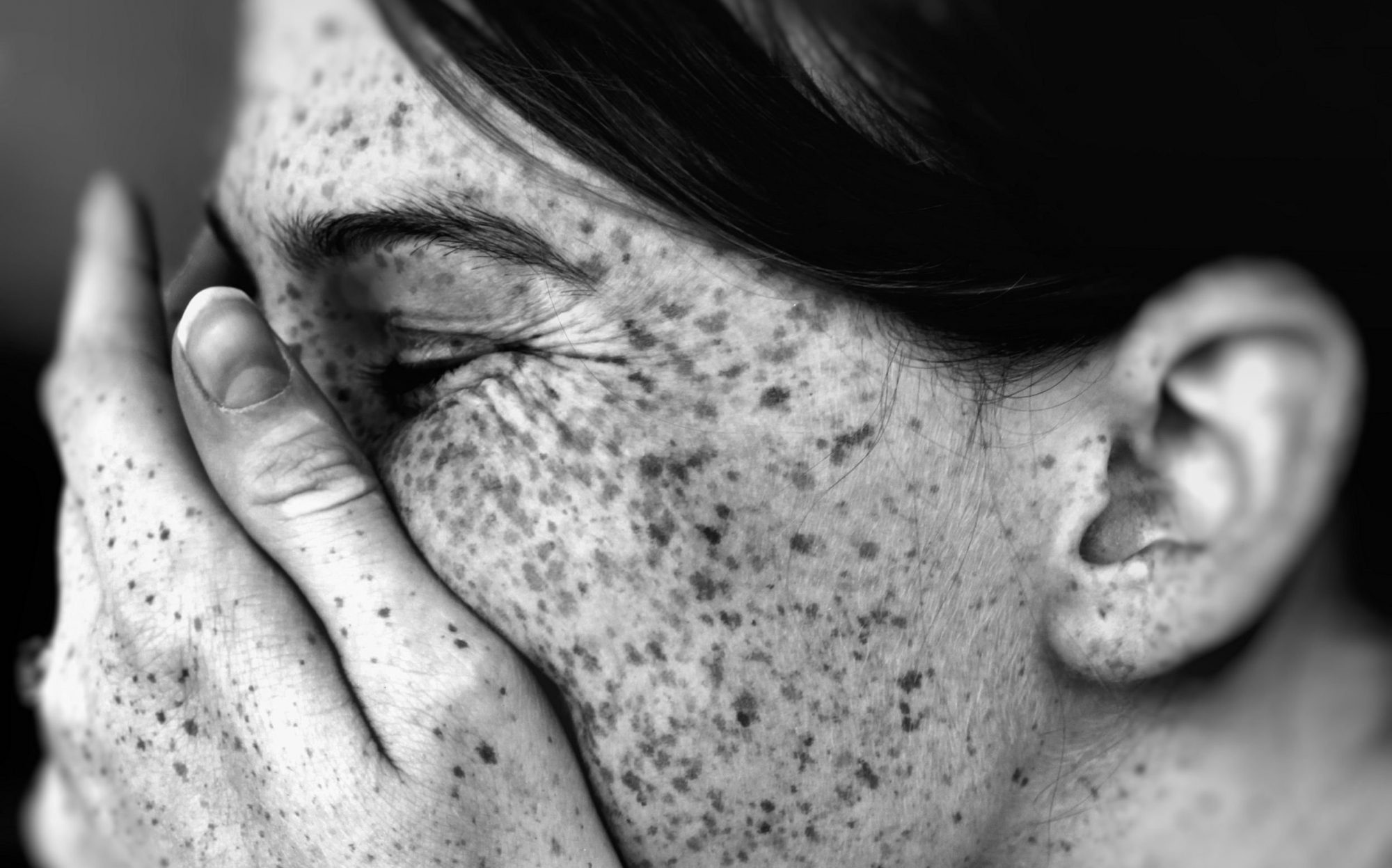 Freckle Face